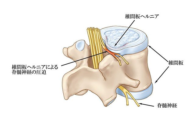 椎間板ヘルニア